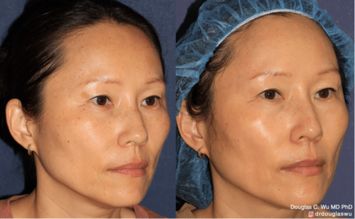 PicoTone laser resurfacing