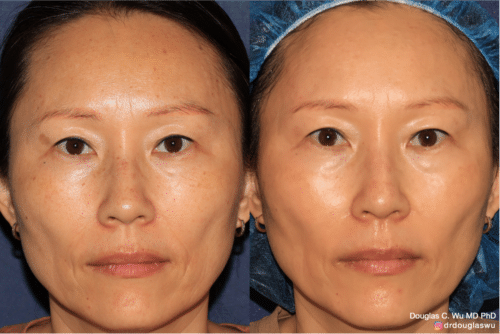 PicoTone laser resurfacing