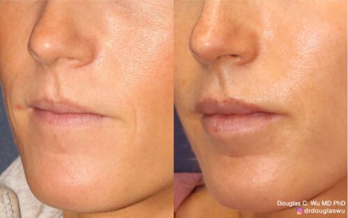 Natural lip volumization