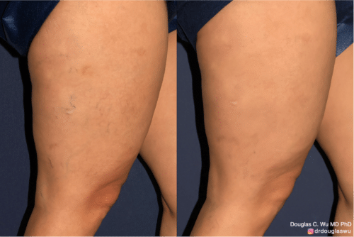 Sclerotherapy to improve the appearance of leg veins