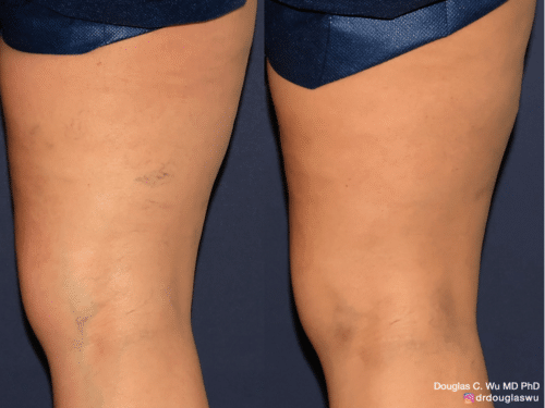 Sclerotherapy to improve the appearance of leg veins