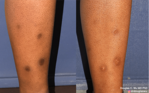 Sclerotherapy to improve the appearance of leg veins