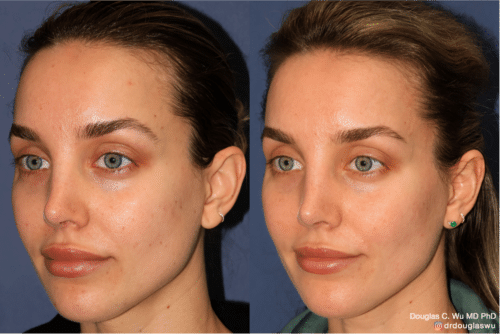 PicoTone laser resurfacing