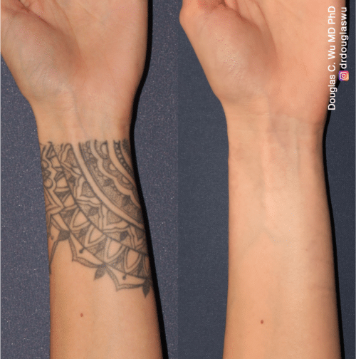 Laser tattoo removal