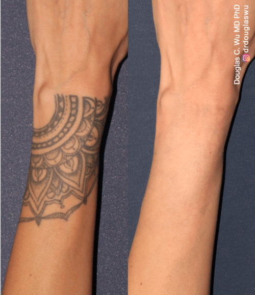 Laser tattoo removal