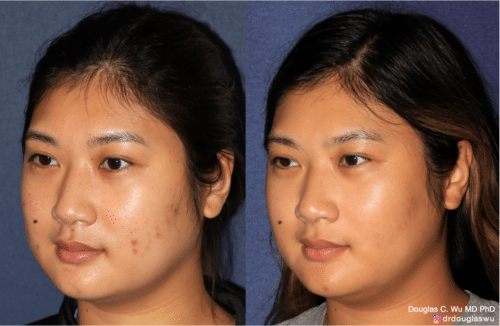 Acne and acne scar removal