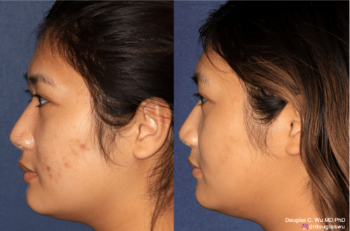 Acne and acne scar removal