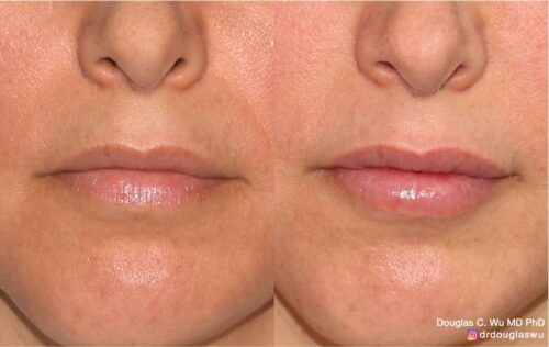 Natural lip volumization