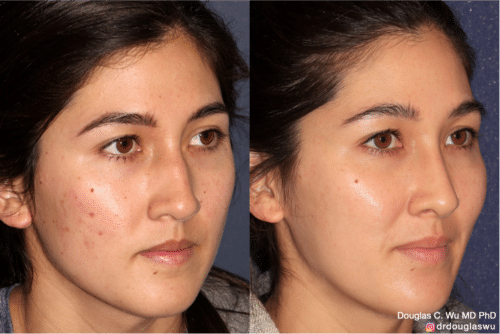 Customized maintenance treatment 10 years later