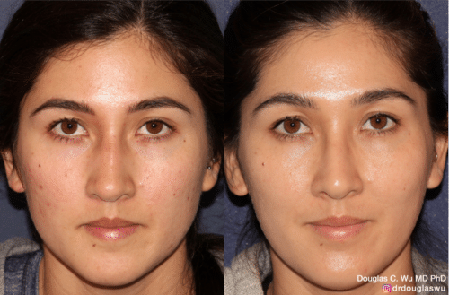 Customized maintenance treatment 10 years later