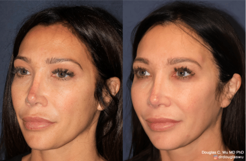 PicoTone laser resurfacing
