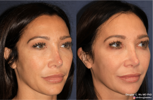 PicoTone laser resurfacing