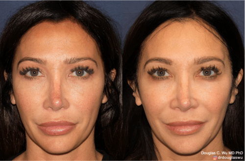 PicoTone laser resurfacing