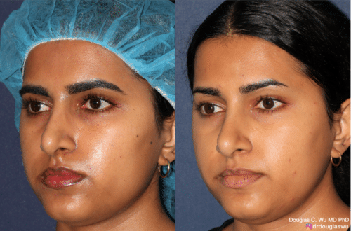 PicoClear for brightening skin tone and spot removal