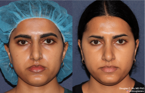 PicoClear for brightening skin tone and spot removal