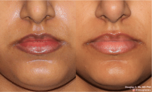Picoway for ethnic lip darkening