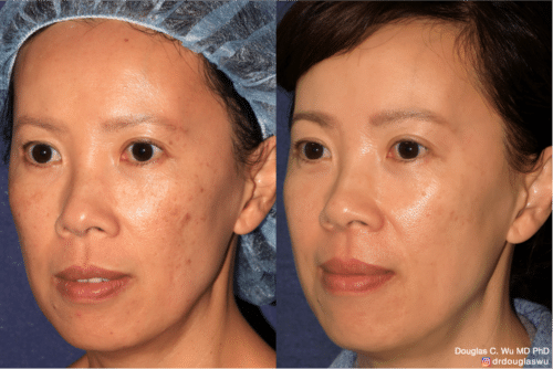PicoUltra laser resurfacing to improve skin tone