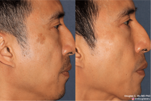 PicoSpot removal