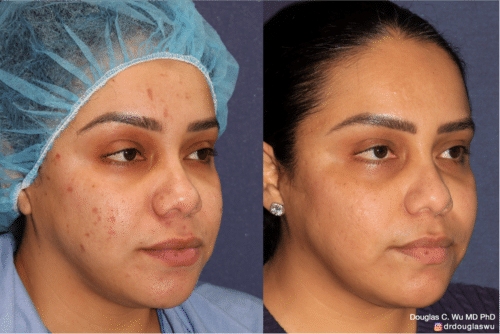 Acne scar treatment