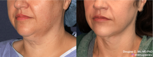 ThermiSculpt to tighten and refine the neck and jawline