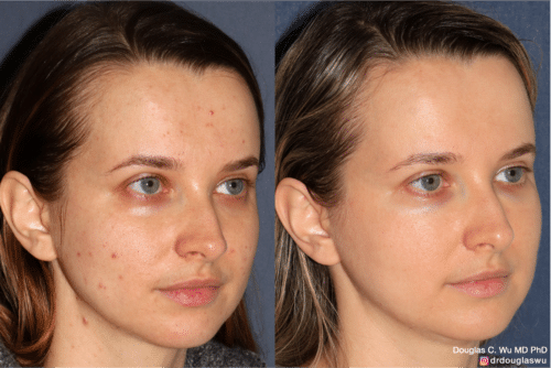 Customized maintenance treatment 5 years later