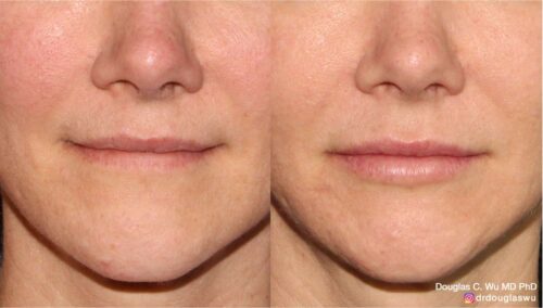 Natural lip volumization