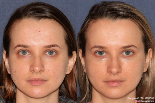 Customized maintenance treatment 5 years later