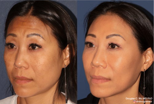 Customized maintenance treatment 5 years later