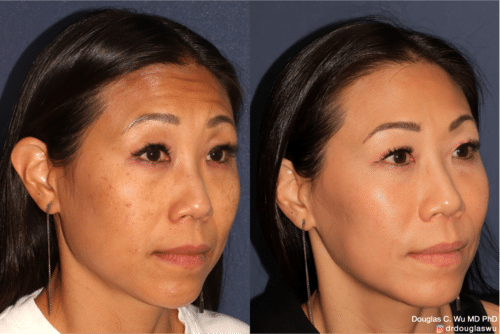 Customized maintenance treatment 5 years later