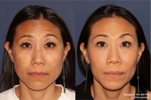 Customized maintenance treatment 5 years later