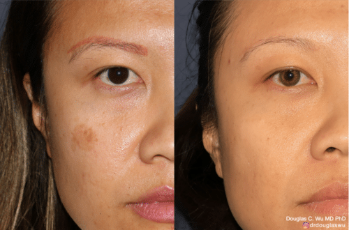 Microblading tattoo and spot removal