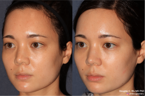 PicoClear for brightening skin tone