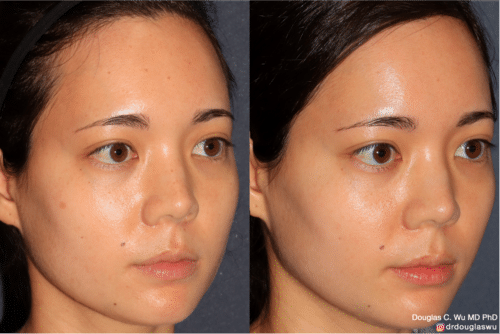 PicoClear for brightening skin tone