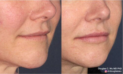 Natural lip volumization