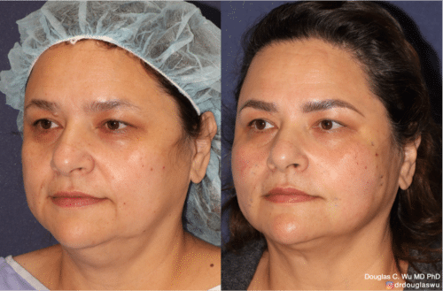 Silhouette Instalift thread lift