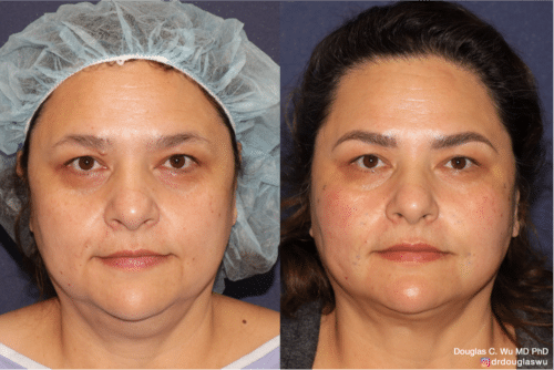 Silhouette Instalift thread lift