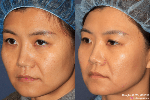 PicoClear for brightening skin tone and spot removal