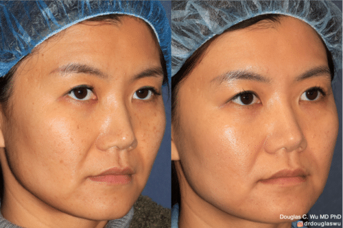 PicoClear for brightening skin tone and spot removal