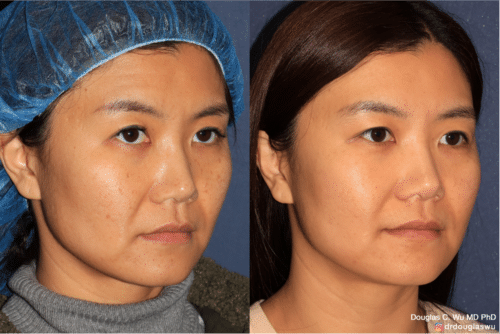 PicoClear for brightening skin tone and spot removal