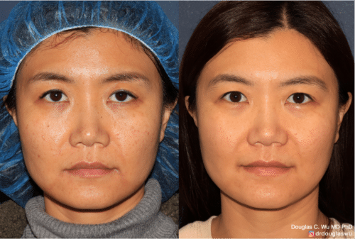 PicoClear for brightening skin tone and spot removal