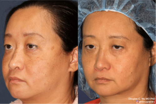 PicoClear for brightening skin tone and spot removal