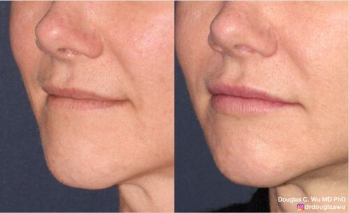 Natural lip volumization