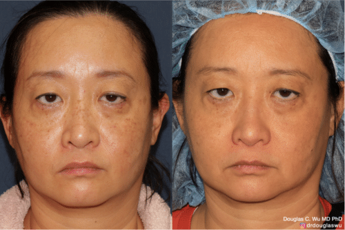 PicoClear for brightening skin tone and spot removal