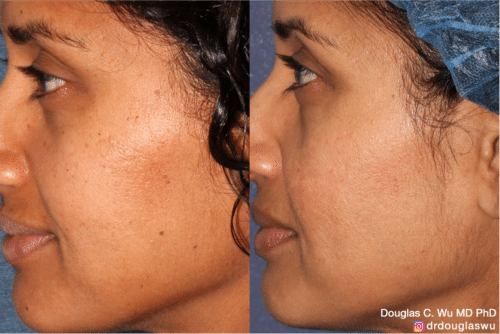 PicoClear for brightening skin tone and spot removal