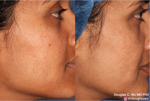 PicoClear for brightening skin tone and spot removal