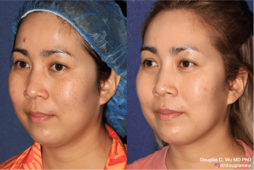 PicoClear for brightening skin tone and spot removal
