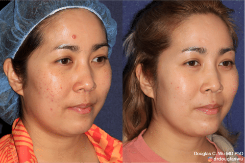 PicoClear for brightening skin tone and spot removal