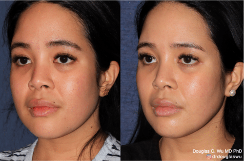 PicoClear for brightening skin tone and spot removal