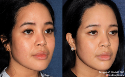PicoClear for brightening skin tone and spot removal