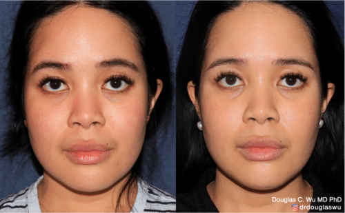 PicoClear for brightening skin tone and spot removal